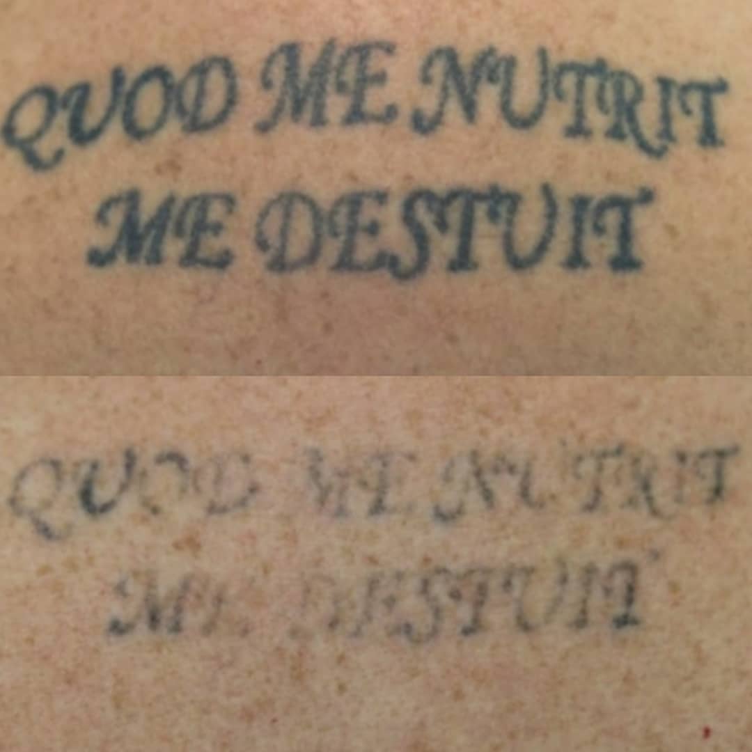 Tatuiruočių šalinimas lazeriu