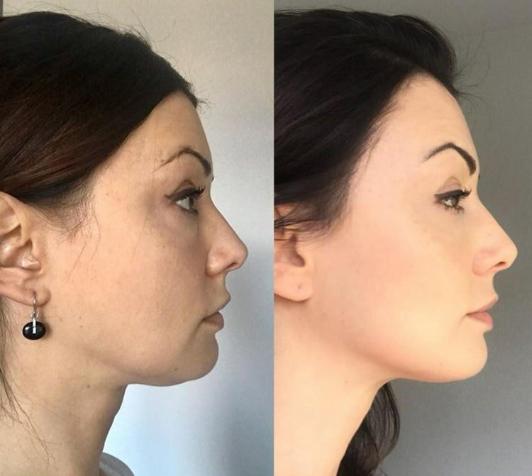 Păstrați bărbia și obrajii mai fermi cu practica regulată de yoga