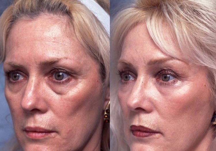 Yoga pentru față strânge pielea și creează un aspect tineresc