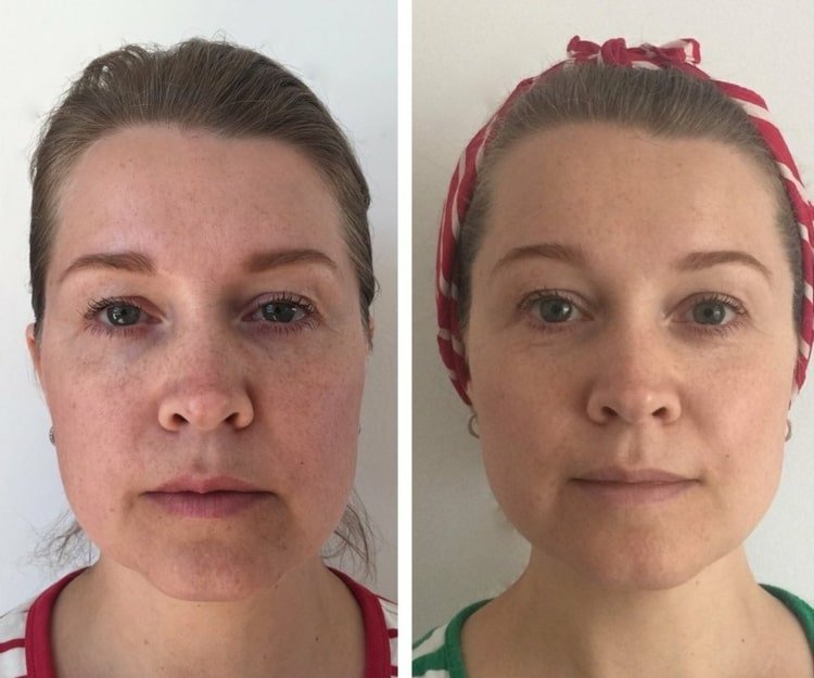 Îmbunătățește tenul datorită unei mai bune circulații a sângelui prin exerciții faciale cu yoga