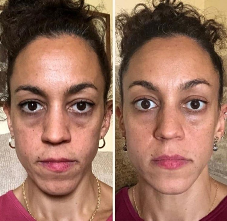 Genti sub ochi înainte și după yoga obișnuită pentru față