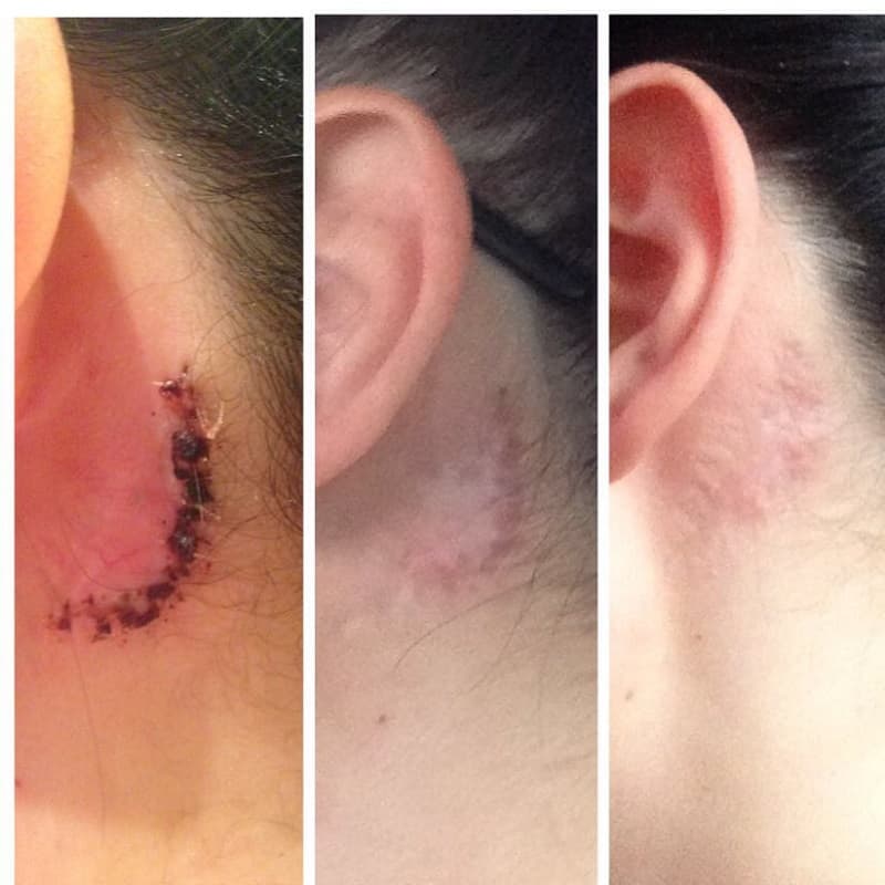 Après un détatouage chirurgical avec une cicatrice