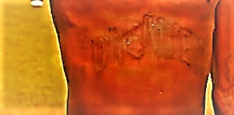 Moise胃の入れ墨