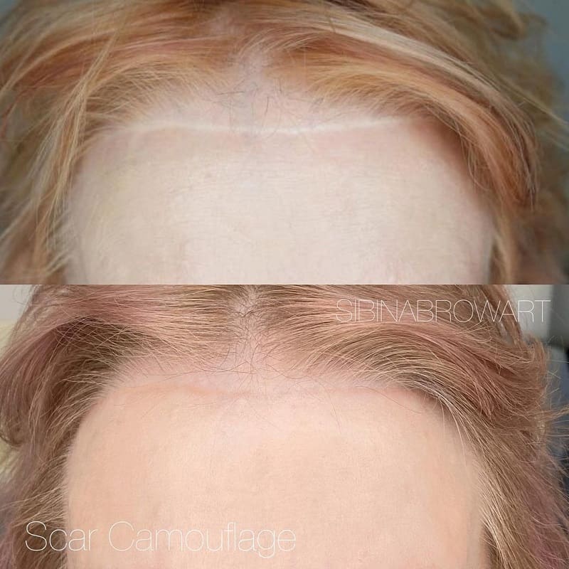 皮膚の色の傷跡の入れ墨とは何ですか